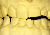 Unusual TMD Cases - Unusual Treatment