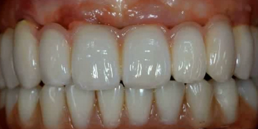 Edentulous Jaw and Different Implant Treatment Options