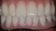 The Edentulous Jaw Restoration: An evaluation of different restorative options