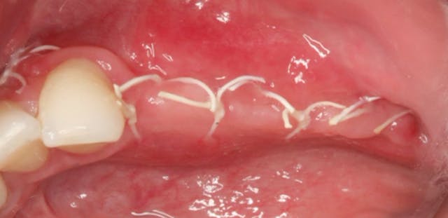 CLINICAL VIDEO Horizontal Ridge Augme...