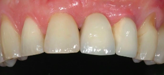 CLINICAL VIDEO Vertical Ridge Augmentation - 2-Stage Vertical Ridge Aug