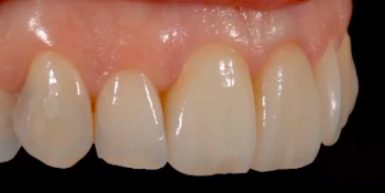 Immediate Tooth Replacement: Review, Articles, and Cases | Dr Francesco Mintrone