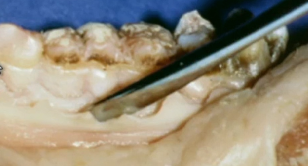 Functional Crown Lengthening for More Predictable Restorative