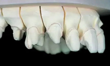 Predictable Anterior Aesthetics with Veneers - Interdisciplinary Approach