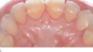 Tips & Tricks: Worn Dentition? Direct (Index Technique) and Indirect (Composite