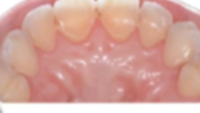 Tips & Tricks: Worn Dentition? Direct (Index Technique) and Indirect (Composite