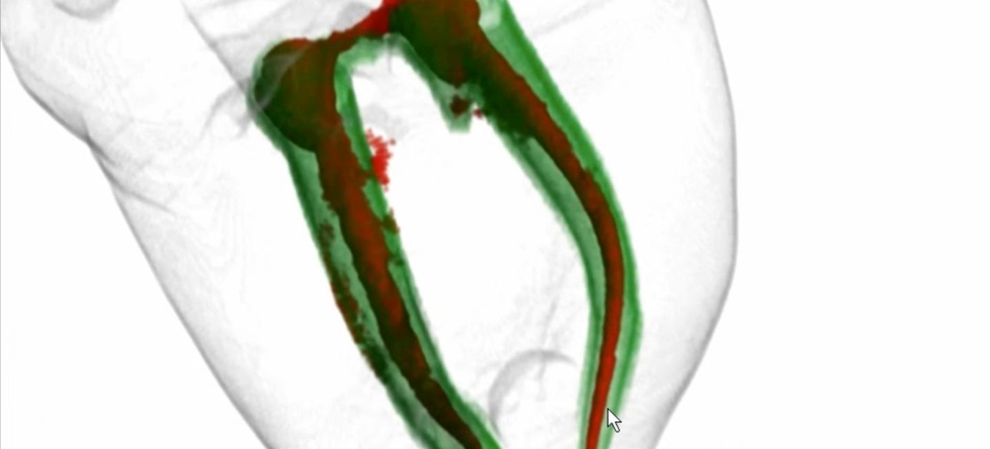 Endo or Implant: Rational decision making from an Endodontist's viewpoint