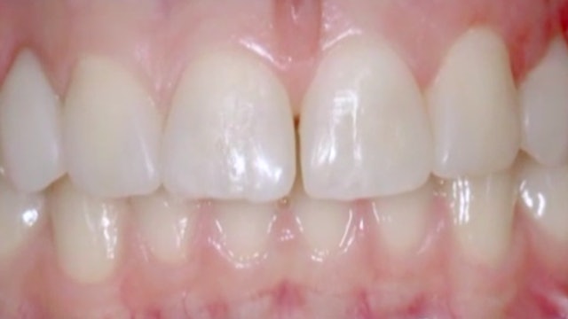 CLINICAL VIDEO Treatment of 6 anterior damaged teeth with Composite direct Venee