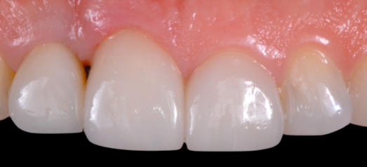 CLINICAL VIDEO NARRATED Immediate Tooth Replacement with Simultaneous Socket and