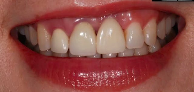 A-Z in Restorative Implant Dentistry ...