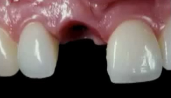 Perio-prosthetic Considerations Around Dental Implants