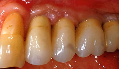Soft Tissue Management and Grafting around Dental Implants - Esthetic and Mucog