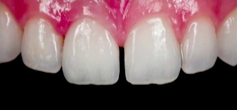 The Evolution of Zirconia in Dentistry