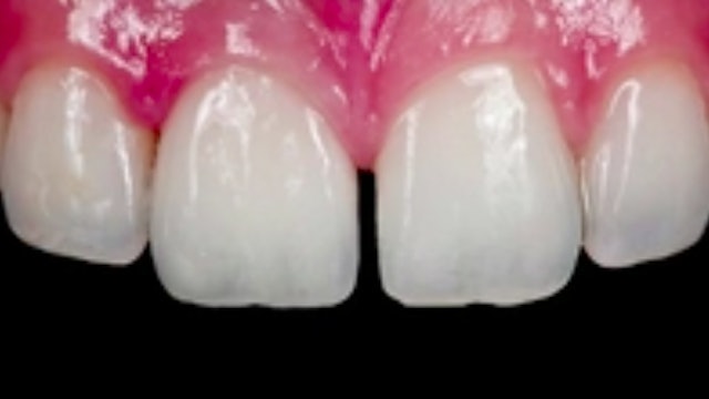 The Evolution of Zirconia in Dentistry