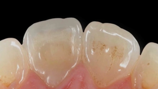 Immediate Dentin Sealing. 20+ Years Experience. 20+ Reasons to Do It.