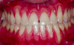 Corticotomy-Assisted Orthodontics