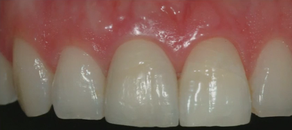 Extraction Site Management for Alveolar Ridge Preservation