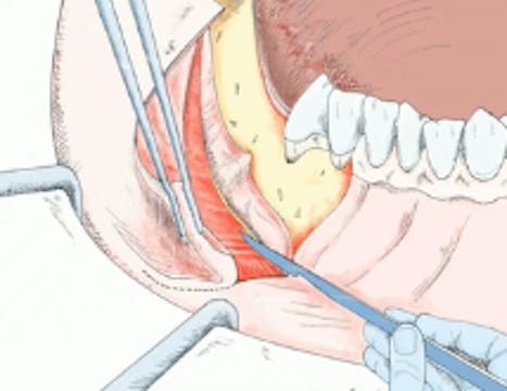 GBR Series (Part 3 of 4) - Surgical P...