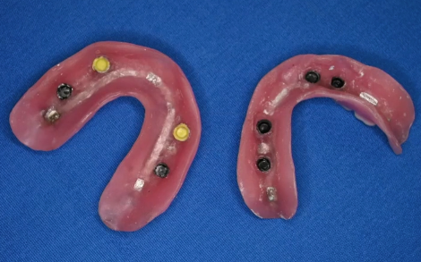 Treating The Edentulous Arch With Removable Implant Overdentures - Jaw ...