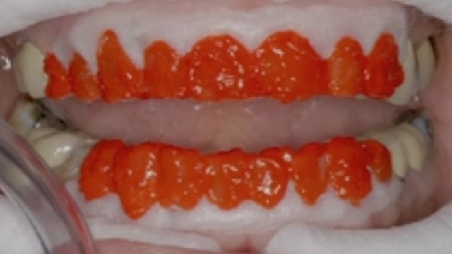 Comparison and Contrast of Direct vs. Indirect Anterior Restorations in Natural