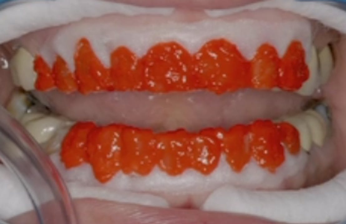 Comparison and Contrast of Direct vs. Indirect Anterior Restorations in