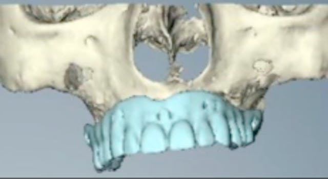 CLINICAL VIDEO Zygomatic Implants - T...