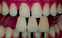 Color in Dentistry – Communication with the Lab | Dr Johan Figueira