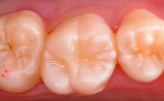 Course Preview – Direct Bonding Restorations