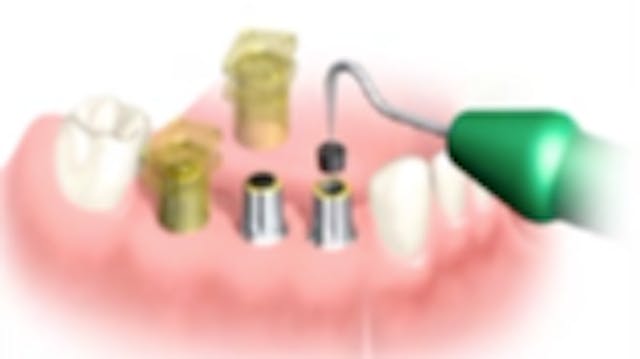 Impression Techniques in Implant Dent...