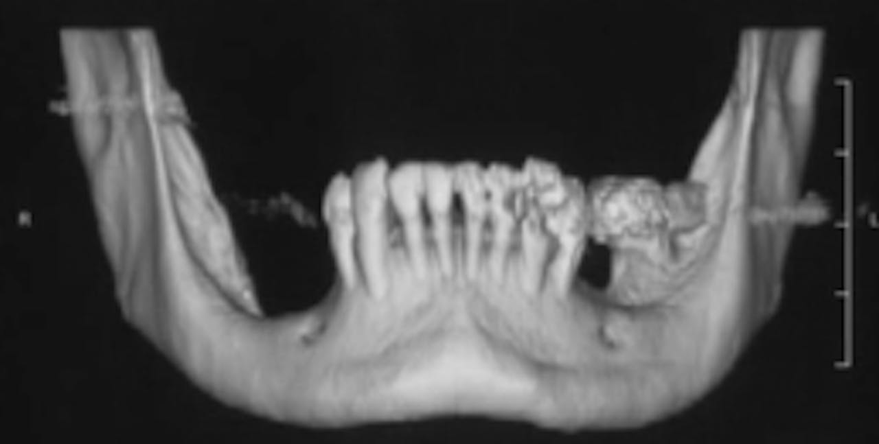 Vertical ridge augmentation using GBR procedures gIDE Dental Institute