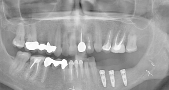 CLINICAL VIDEO Implant Placement 12 months after Horizontal Ridge Augmentation i