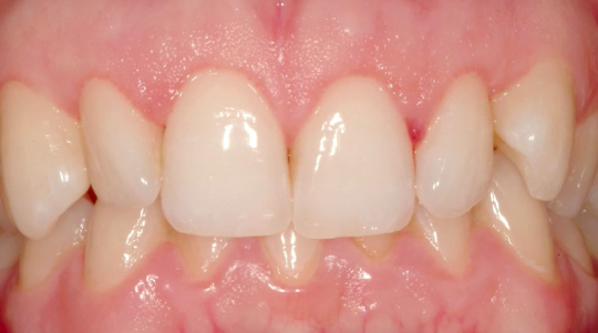 Creating a Framework for the Perfect Smile - Aesthetic Enhancement through Crow