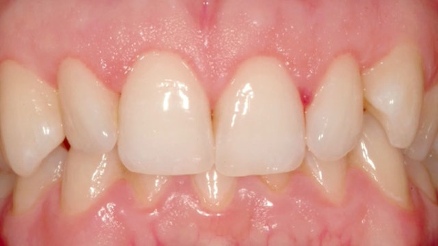 Creating a Framework for the Perfect Smile - Aesthetic Enhancement through Crow