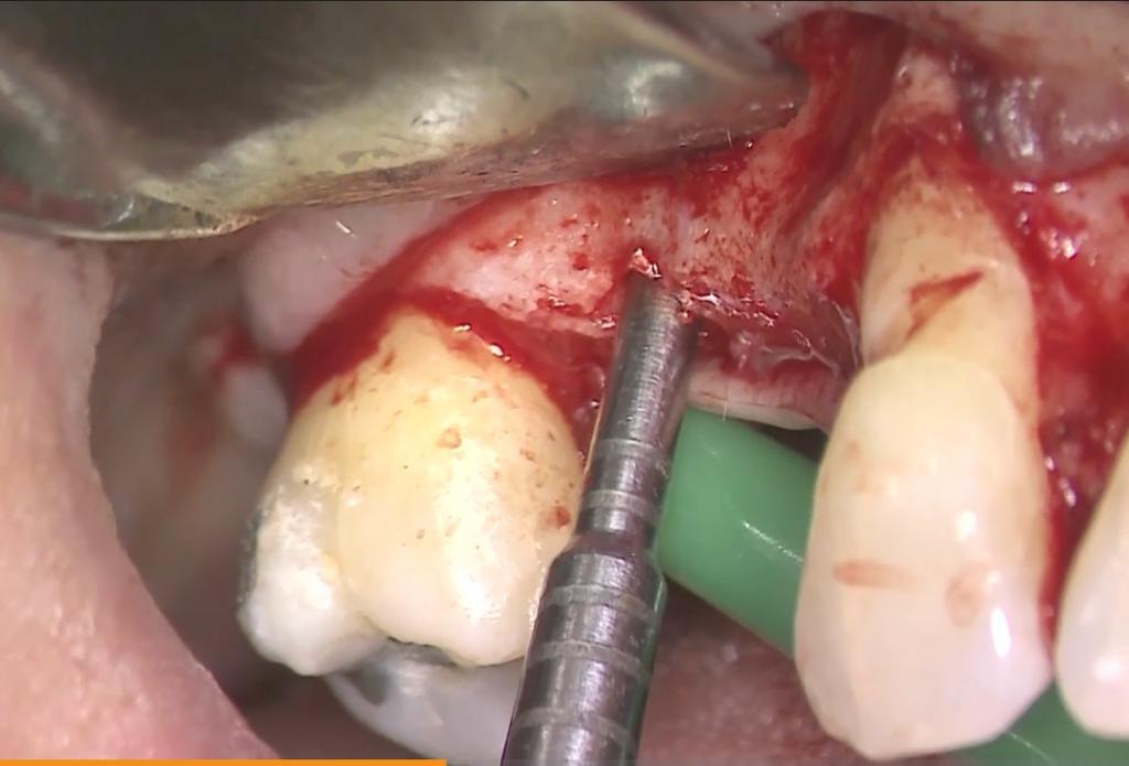 CLINICAL VIDEO Management of the Peri-Implant Soft Tissue Deformities in the