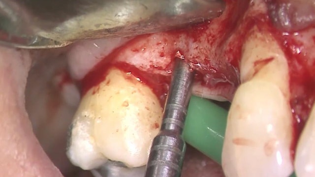 CLINICAL VIDEO Management of the Peri-Implant Soft Tissue Deformities in the