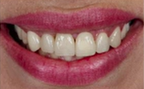 Ridge Augmentation – Decision Tree | Dr Robert Carvalho da Silva