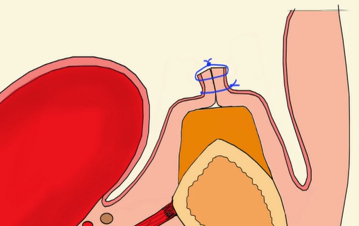 CLINICAL VIDEO-How to release the periosteum of the lingual flap forGBR|Rossetti