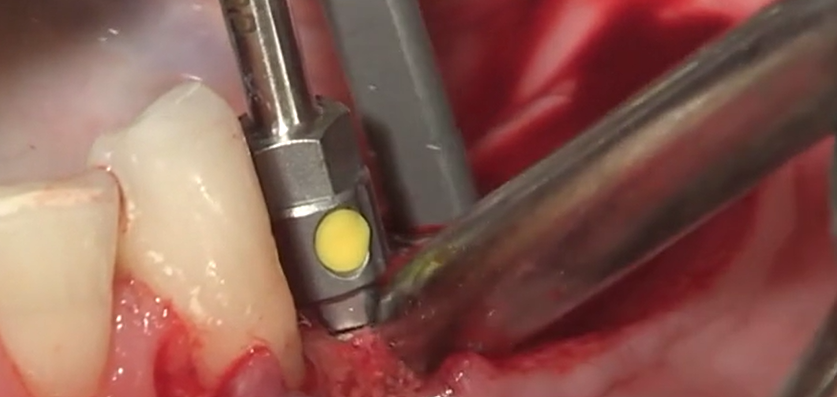  CLINICAL VIDEO Horizontal Ridge Augmentation in a thin Posterior Mandible