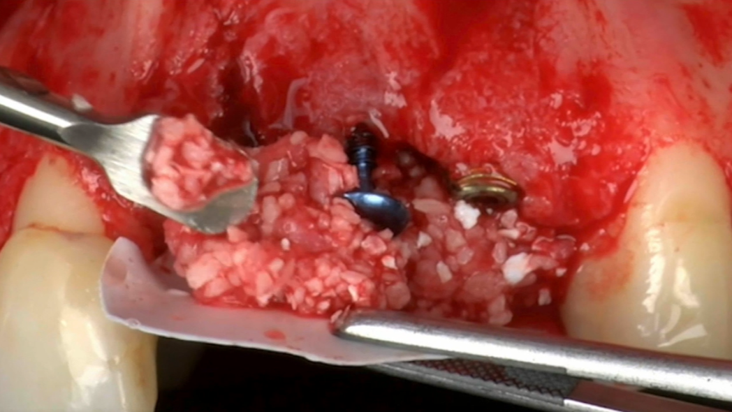 CLINICAL VIDEO Advanced GBR Augmentation and Implant Placement in a Challenging 