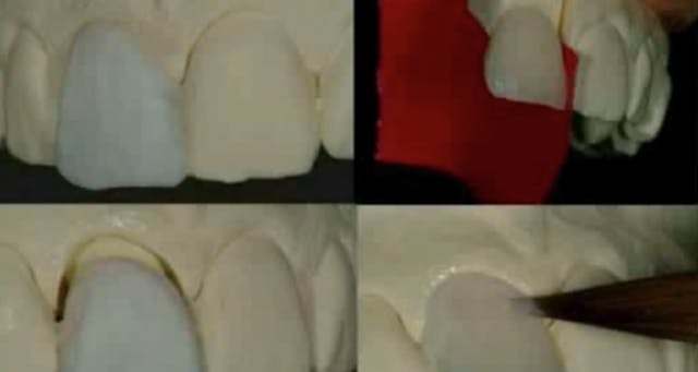 Esthetic Restorations : All-Ceramic A...