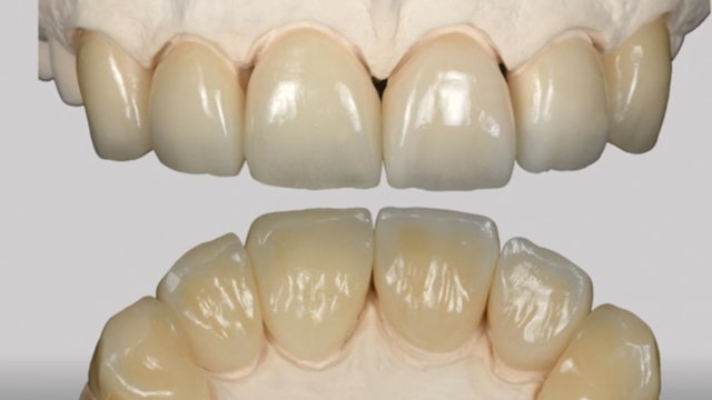 Tooth wear Interceptive & Conservative Treatment