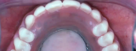 A-Z in Restorative Implant Dentistry (Part 7a) - Mastering the Edentulous Patie