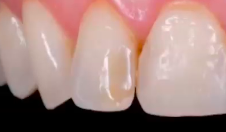 Immediate Tooth Replacement: Review, Articles, and Cases | Dr Francesco Mintrone