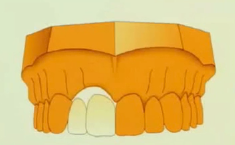 Anterior Implant Restoration: Beginning Considerations and Issues