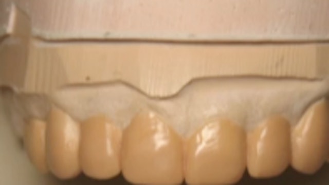 A New Common Sense Approach to Full Mouth Rehabilitation Using Direct Composite