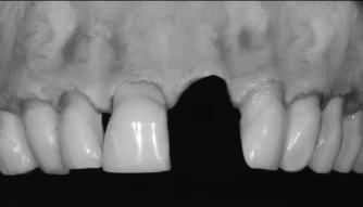 Bone Regeneration in the Anterior Sites - From Small to Large