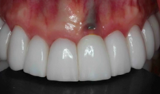 333_00 Evidence and Clinically Based Protocols in Implant Dentistry Part 02