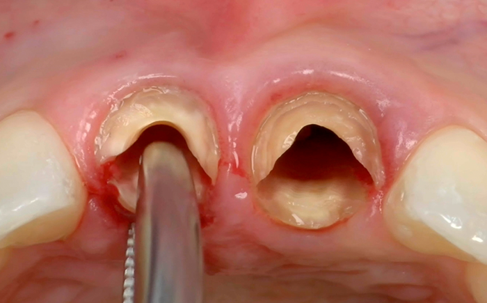 CLINICAL VIDEO Extraction Management in the Esthetic Zone using Socket Shield