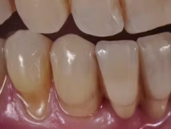  Clinical Strategies on Integration and Reliability of Prosthetic Outcome,Fabbri