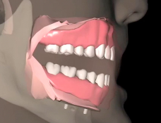 Treating the Edentulous Arch with Removable Implant Overdentures - Impression